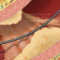Atheromatous Arterial Plaque v2.72