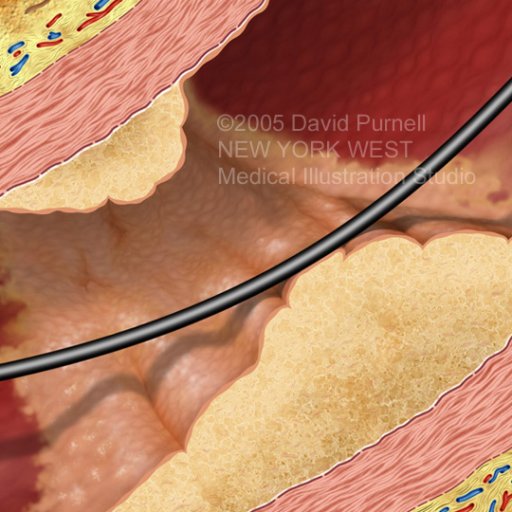 Atheromatous Arterial Plaque v2.72