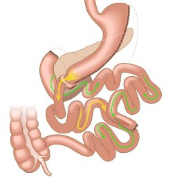 504.2 Duodenal Switch_REV_72ppi.jpg